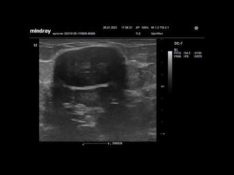 Видео: Ультразвуковая диагностика. Доктор Иогансен. Видеопримеры. Выпуск 27. Фиброаденома молочной железы.