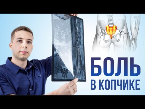 Видео: БОЛЬ В КОПЧИКЕ - кокцигодиния. Почему? Симптомы, лечение, разбор рентгена