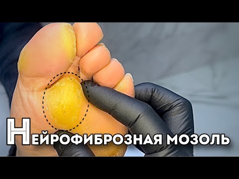 Видео: Рыхлое, волокнистое, разросшаяся соединительная ткань под мозолью