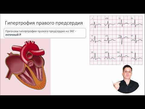 Видео: ЭКГ за 100 минут №6: Гипертрофия сердца на ЭКГ