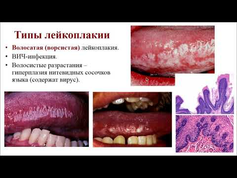 Видео: Электив. Одонтогенные опухоли