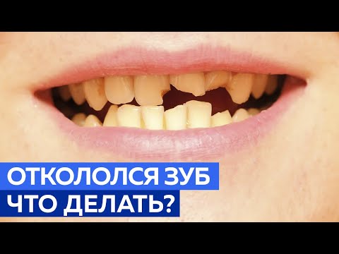 Видео: Зуб откололся, нужно ли его спасать? / Что делать, если откололся зуб?