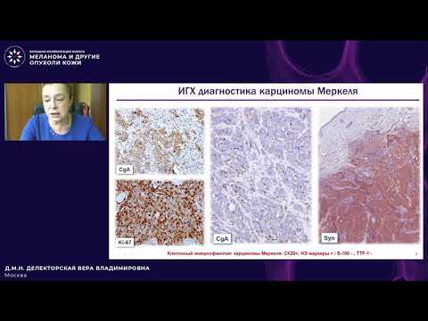 Видео: Особенности морфологической диагностики карциномы Меркеля. Чем морфолог может помочь клиницисту?