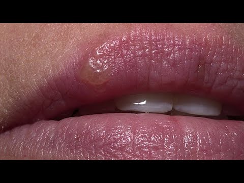 Видео: ПРОСТОЙ ГЕРПЕС: Клиника, терапия и профилактика (проф. Халдин А.А.)