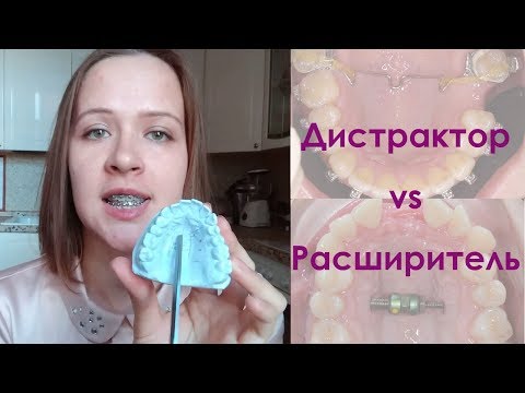 Видео: Расширение верхней челюсти. Дистрактор и расширитель