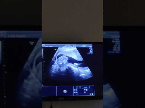 Видео: УЗИ Срок 16 недель. 30.11.2020