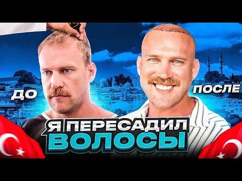 Видео: Как я пересадил волосы. Курс. Восстановление. Турция.