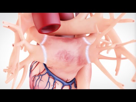 Видео: Фибрилляция предсердий: лечение с помощью криоаблационного катетера