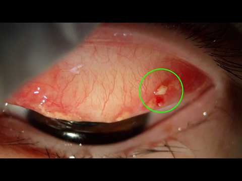 Видео: Удаление конъюнктивного камня — Он тайно царапал глаз. Серия 32.