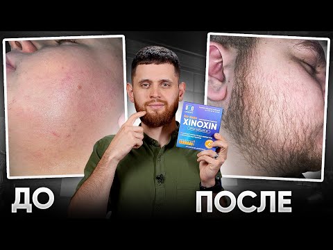Видео: РЕЗУЛЬТАТ КСИНОКСИНА для роста бороды / С НУЛЯ ЗА 3 МЕСЯЦА