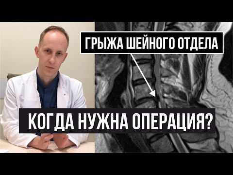 Видео: Грыжа шейного отдела, сдавление спинного мозга и шейная миелопатия