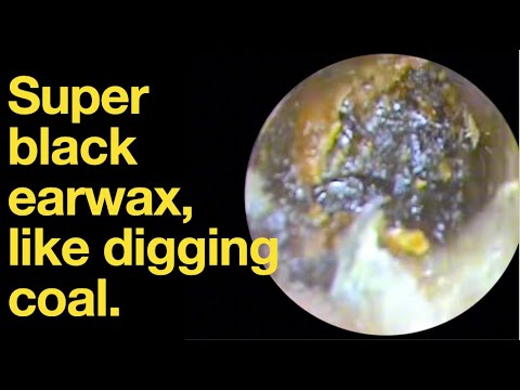 Видео: Очень черная ушная сера, как при добыче угля.