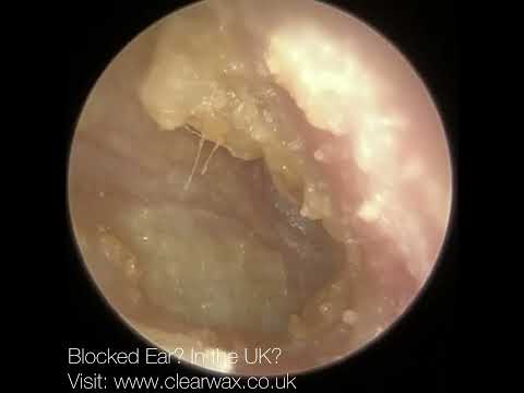 Видео: 1634 пациента снова слышат спустя 6 лет после удаления инфицированной ушной серы