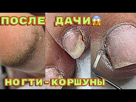 Видео: Педикюр после дачи 🤪 Ногти коршуны / Обработка стоп дисками