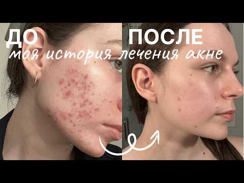 Видео: Как я избавилась от акне | Акнекутан в США: вся правда и побочки