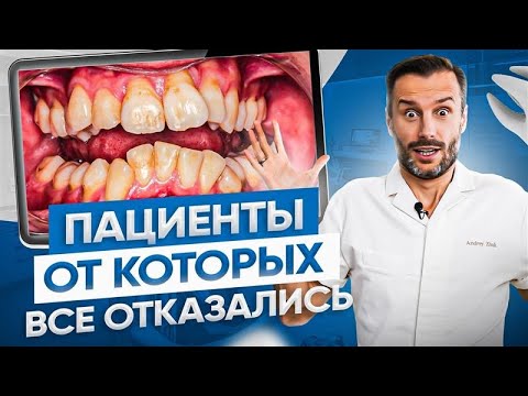 Видео: Самые кривые зубы: от этих 5 пациентов отказались все… Кроме нас! Результаты ДО и ПОСЛЕ