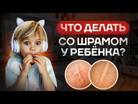 Видео: Убрать ШРАМЫ и РУБЦЫ на теле | Всего за 5 МИНУТ в день | Самый РАБОЧИЙ СПОСОБ от остеопата