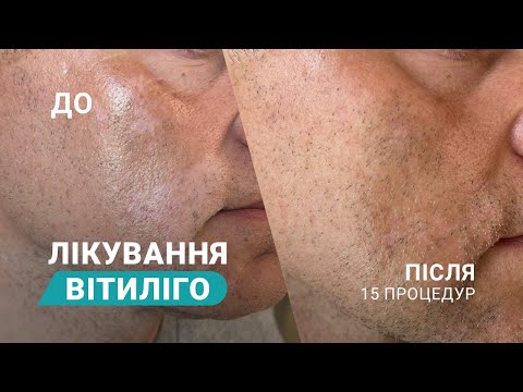 Видео: Лікування вітиліго: до та після