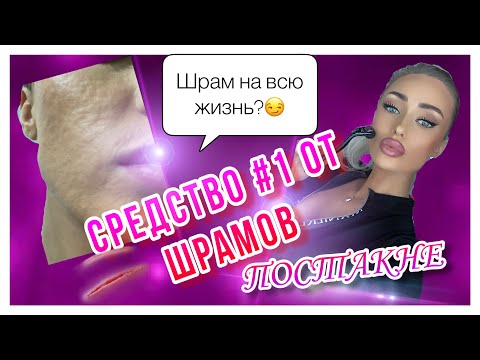 Видео: МЕЗОРОЛЛЕР от ШРАМОВ, РУБЦОВ ПОСТАКНЕ ( выравниваем РЕЛЬЕФ кожи) ! мезороллер в домашних условиях