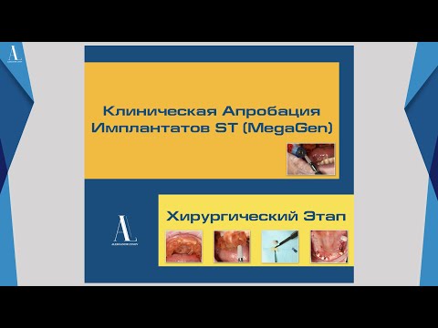 Видео: Апробация Имплантатов ST - MegaGen (Хирургический этап - Установка дентальных имплантатов)