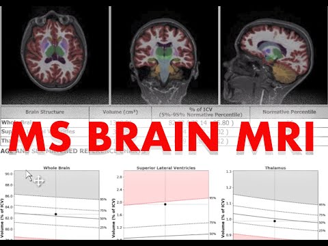 Видео: Поймите, что такое сканирование мозга: МРТ с МС