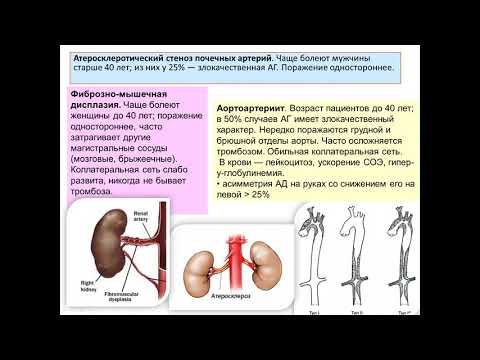 Видео: Симптоматические артериальные гипертензии