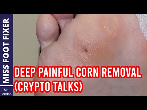 Видео: Удовлетворительное полное удаление глубоких болезненных мозолей от Miss Foot Fixer