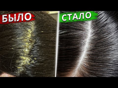 Видео: ПЕРХОТЬ: ТОП 5 ошибок и способы лечения БЕЗ лекарств