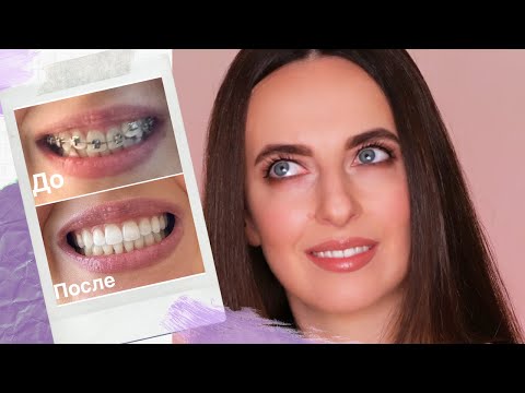Видео: Брекеты | Что случилось с моим прикусом | Год после снятия брекетов