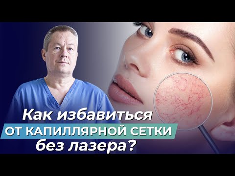 Видео: ЛУЧШИЙ МЕТОД избавиться ОТ СОСУДИСТЫХ ЗВЁЗДОЧЕК! Как вылечить капиллярные сетки на ногах без лазера?