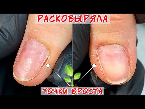 Видео: Перепиленные точки вроста / Расковыряла ногти