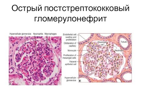 Видео: острый постстрептококковый гломерулонефрит. Часть 2