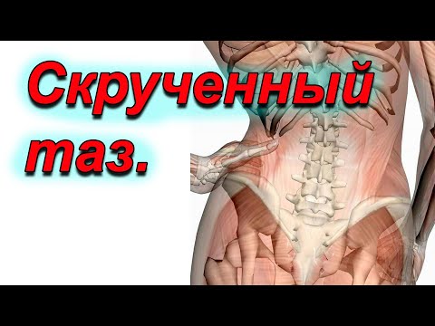 Видео: Скрученный таз.Анализ причин.Ошибки.