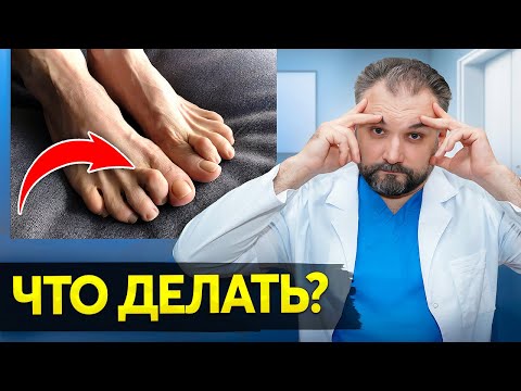 Видео: Молоткообразная Деформация Пальцев НОГ! Причины, Симптомы и Лечение