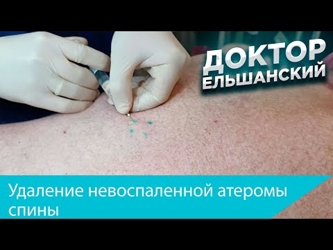 Видео: Удаление невоспаленной атеромы спины