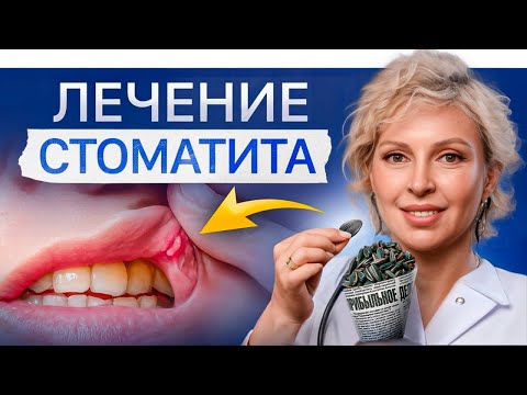 Видео: ТОП 3 способа избавиться от стоматита в домашних условиях