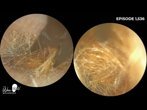 Видео: 1536 — Третий раз, почти наверняка, снова удаление ушной серы | Обсуждение волосатых ушей