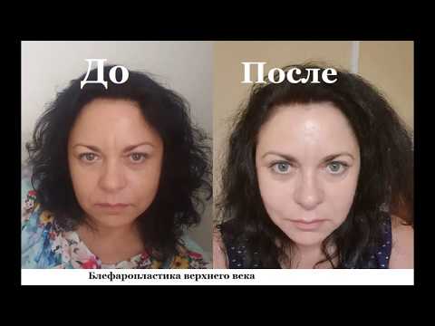 Видео: Блефаропластика верхних век. Реабилитация по дням I  Мой опыт.