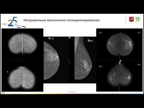 Видео: Маммография  критерии качества, разбор сложных случаев
