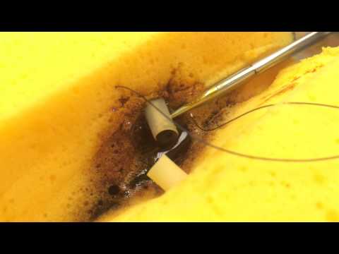 Видео: Сосудистая лигирование: восьмиобразный шов