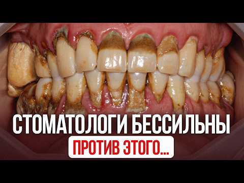 Видео: Самая коварная болезнь во рту, от которой выпадут ВСЕ зубы / Что делать?