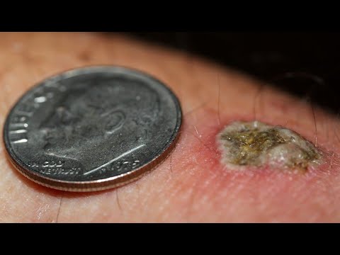 Видео: Плоскоклеточный рак кожи