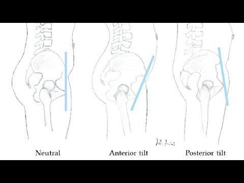 Видео: Як поставити таз на місце. Частина 2