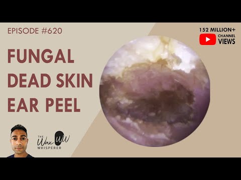 Видео: 620 - Грибковая омертвевшая кожа отслаивается со всего ушного канала и барабанной перепонки