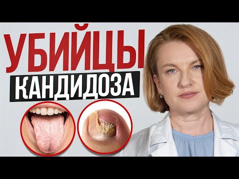 Видео: Молочница НЕ ПРОЙДЕТ, пока ты делаешь ЭТО / Все о причинах кандидоза и как их исправить
