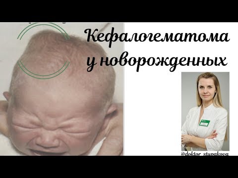 Видео: Кефалогематома у новорожденных. К кому обратиться из докторов.Что это такое?