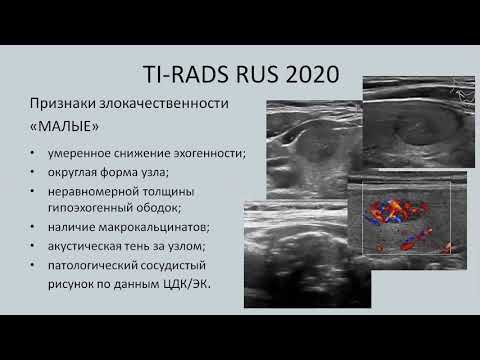 Видео: 2. Ультразвуковые критерии дифференциальной диагностики фолликулярных опухолей щитовидной железы