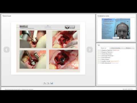 Видео: 2014 03 18 Одномоментная имплантация и немедленная нагрузка  0001