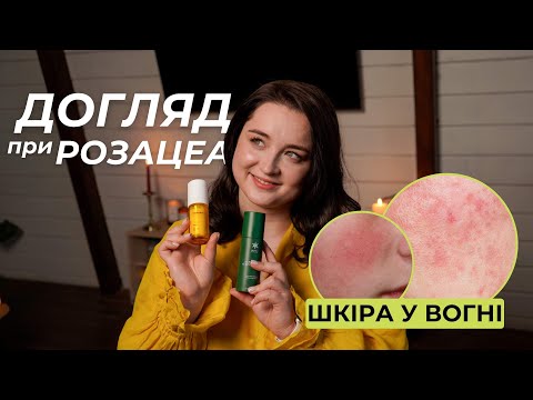 Видео: Чи правда розацеа таке страшне, як про нього говорять?