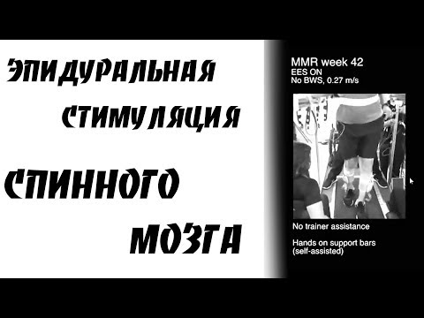 Видео: Эпидуральная стимуляция спинного мозга